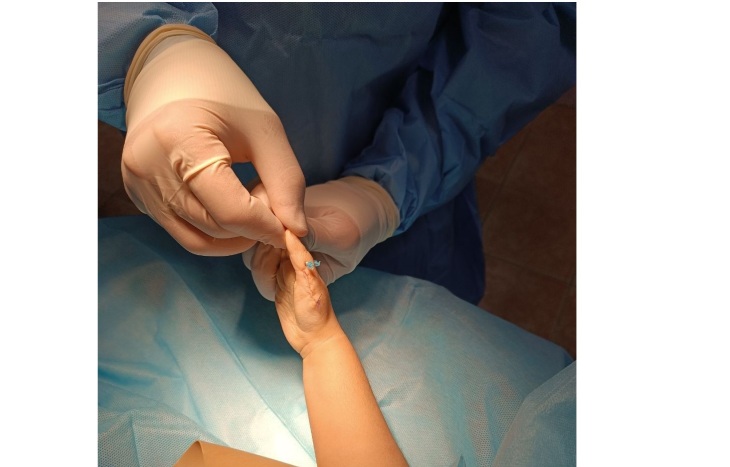 Тюменские врачи помогли двухлетней девочке с дефектом пальцев рук