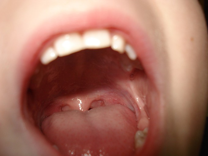 В детскому саду Тюмени ребенку выбили зуб